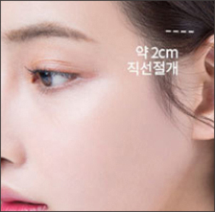 Step 2 making a minimal 2cm incision along the inside of the scalp hairline in micro facelift at NANA