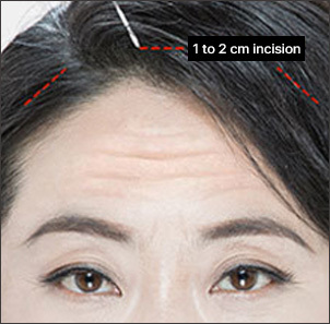 Step 1 making a 1 to 2cm incision inside the hairline for endoscopic forehead lift at NANA