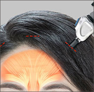 Step 2 inserting an endoscope to uniformly dissect the forehead in forehead lift surgery at NANA