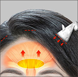 Step 3 lifting sagging areas and fixing them with Endotine to distribute force in forehead lift at NANA