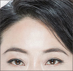 Step 4 semi-permanent rejuvenated facial contour achieved after endoscopic forehead lift at NANA