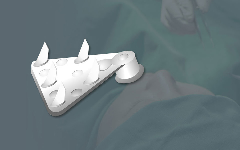 Endotine absorbable implant with five protrusions FDA approved for forehead lift tissue fixation at NANA