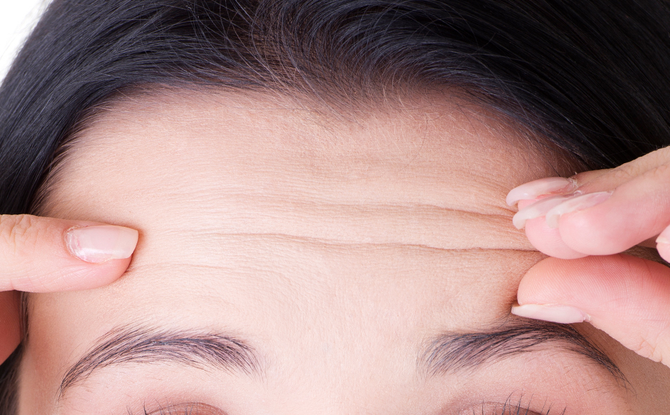 Forehead lift candidate 5 severe wrinkles on the glabella or forehead requiring lift at NANA