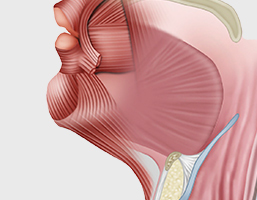 Step 4 tightening neck muscles up to below the chin to improve wrinkles and fat in platysmaplasty at NANA