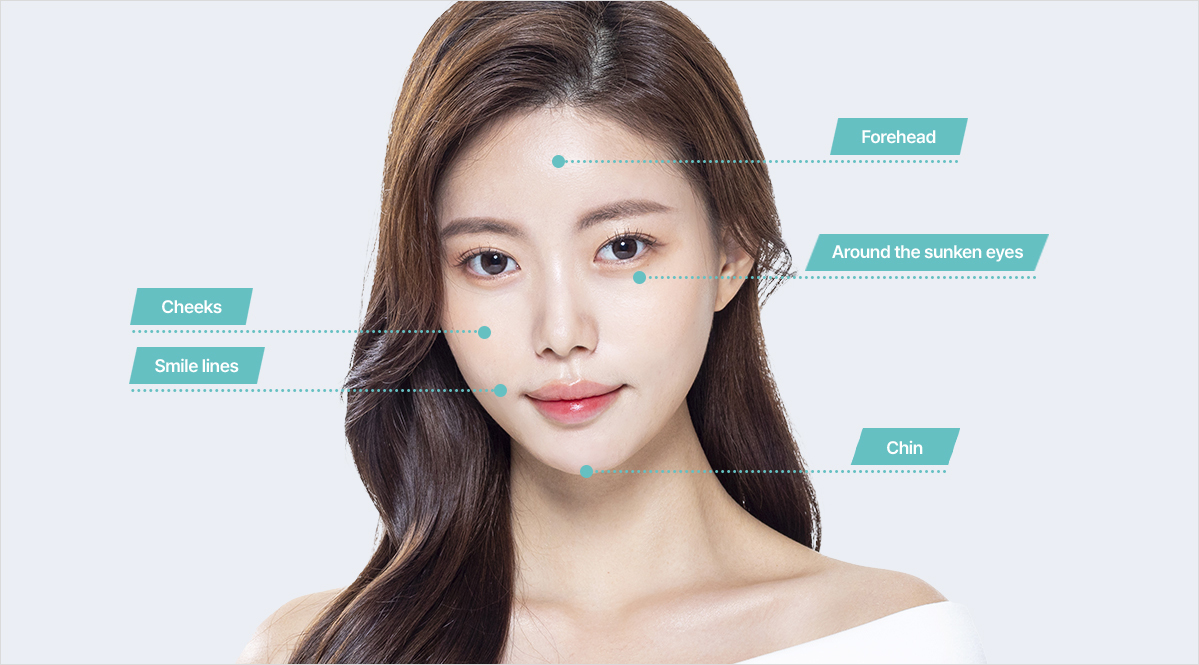 PRP fat grafting treatment areas face cheeks forehead and hollow areas at NANA Plastic Surgery Korea