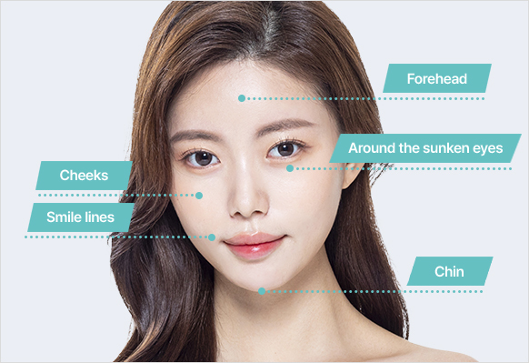 PRP fat grafting treatment areas face cheeks forehead and hollow areas at NANA Plastic Surgery Korea