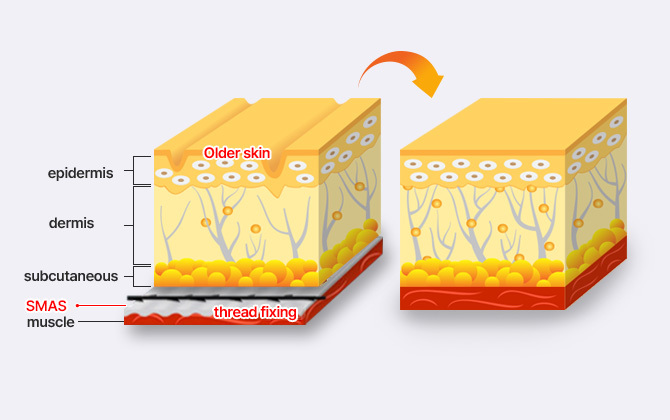 Securing skin and fascia layers with threads to prevent aging fascia tearing and ensure long-lasting lift at NANA