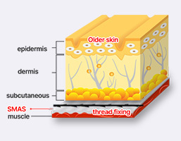 Step 2 inserting threads into sagging fascia to create a supportive SMAS layer in mini facelift at NANA