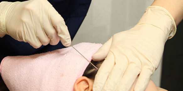 Inserting threads in direction of sagging around earline hairline cheekline and laugh lines at NANA