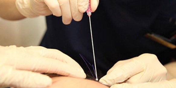 Securing threads in firm fibrous layer for stronger and longer lasting thread lifting effect at NANA