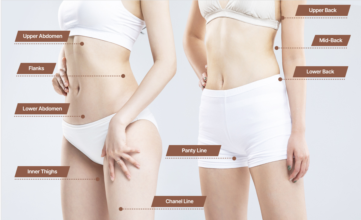 Surgical areas for mini liposuction showing targeted body zones at NANA Plastic Surgery Korea