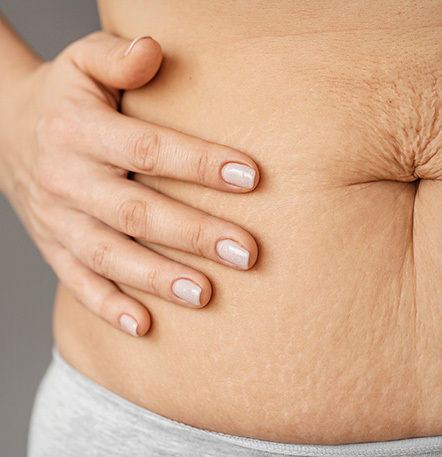 Tummy tuck improving skin elasticity by removing excess skin above navel at NANA Plastic Surgery