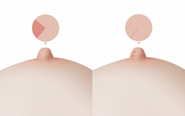 Wide nipple reduction surgery procedure diagram
