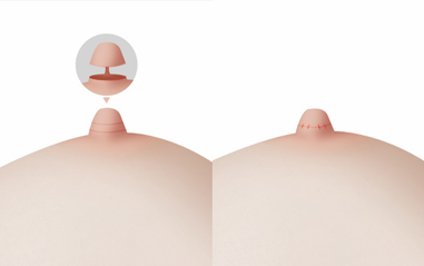 Long nipple reduction surgery procedure diagram