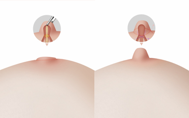 Buried nipple correction surgery procedure diagram