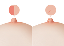 Wide nipple reduction surgery procedure diagram