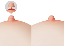 Long nipple reduction surgery procedure diagram