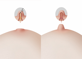 Buried nipple correction surgery procedure diagram