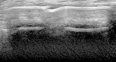 Breast augmentation examination through ultrasound pre and post surgery implant condition assessment