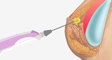 Minimal incision excision surgery suitable for complex dense breast conditions