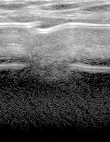 Breast augmentation examination through ultrasound pre and post surgery implant condition assessment