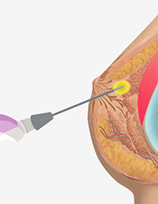 Minimal incision excision surgery suitable for complex dense breast conditions