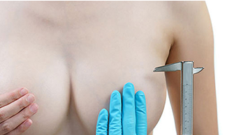 Giant breast definition breast weighing over 400cc per side causing physical and cosmetic problems