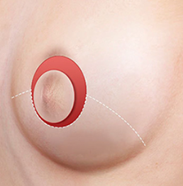 Vertical incision breast reduction STEP01 removal of epidermal layer after incision