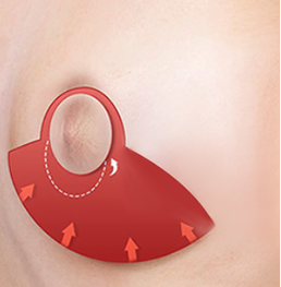 Vertical incision breast reduction STEP02 excision and removal of sagging glandular and skin tissues