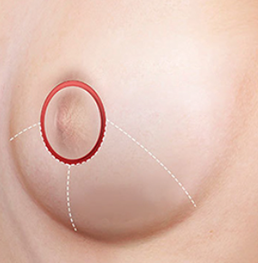Vertical incision breast reduction STEP03 closure of incision site