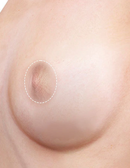 Vertical incision breast reduction result natural breast shape after surgery