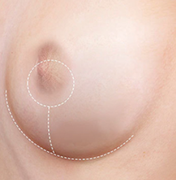 Inverted-T incision breast reduction STEP01 removal of epidermal layer after inverted-T incision