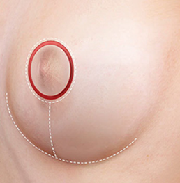 Inverted-T incision breast reduction STEP02 excision of sagging tissues and nipple position adjustment