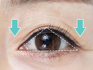 Eye shape distortion and forehead wrinkles caused by drooping eyelids requiring upper blepharoplasty at NANA