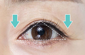 Eye shape distortion and forehead wrinkles caused by drooping eyelids requiring upper blepharoplasty at NANA