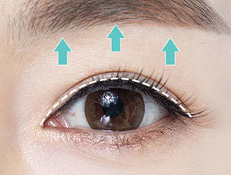 Natural anti-aging result through skin tightening and levator muscle fixation in upper blepharoplasty at NANA