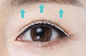 Natural anti-aging result through skin tightening and levator muscle fixation in upper blepharoplasty at NANA