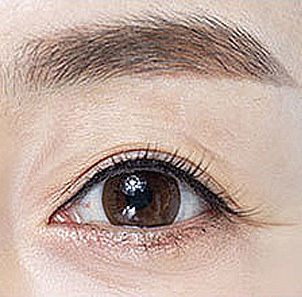 Step 1 assessing degree of skin sagging and individual factors for upper blepharoplasty design at NANA