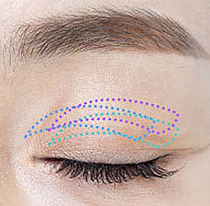 Step 2 determining incision line and extent based on individual eye shape and aging level at NANA
