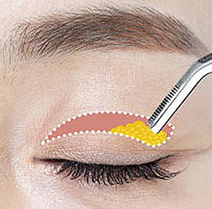 Step 3 removing excess skin fat and orbicularis oculi muscle in upper blepharoplasty at NANA