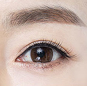 Step 4 precise suturing of skin and levator muscle for natural clear eye shape after upper blepharoplasty at NANA