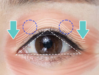 Correcting the orbicularis oculi muscle to restore natural eye shape during brow lift at NANA