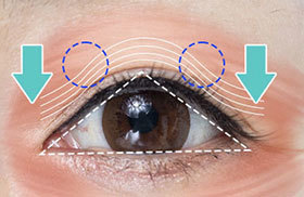 Correcting the orbicularis oculi muscle to restore natural eye shape during brow lift at NANA