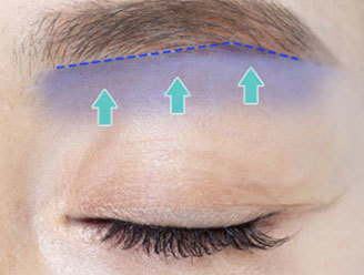 Maintaining natural eye shape while reducing recurrence of eyelid sagging with brow lift at NANA