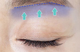 Maintaining natural eye shape while reducing recurrence of eyelid sagging with brow lift at NANA