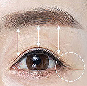 Step 1 customized brow lift design based on individual consultation at NANA Plastic Surgery