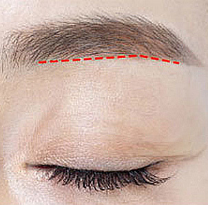 Step 2 precise incision just below the eyebrow for minimal scarring in brow lift at NANA