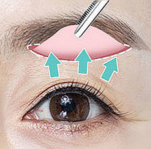 Step 3 removing excess skin and orbicularis oculi muscle to achieve brow lifting effect at NANA