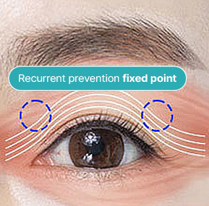 Step 4 securing the brow to the periosteum and anchoring the orbicularis oculi muscle at NANA