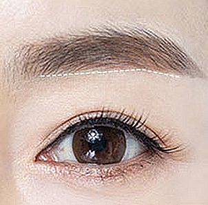 Step 5 careful suturing to ensure minimal visible scarring after brow lift at NANA